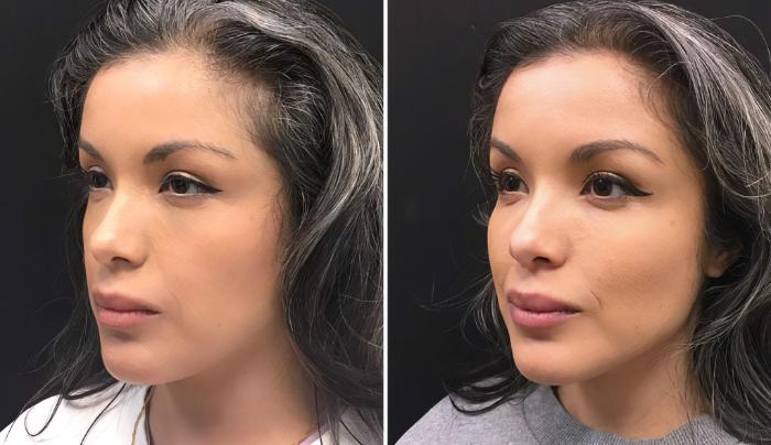 Injectables & Fillers Before & After Case 26633