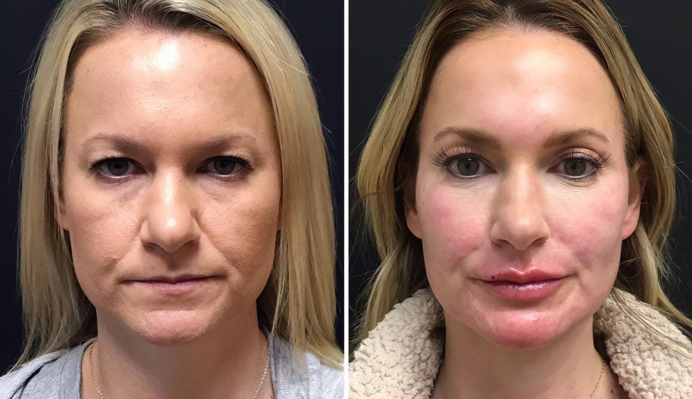 Injectables & Fillers Before & After Case 26636
