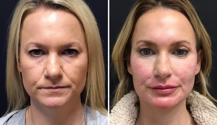 Injectables & Fillers Before & After Case 26636