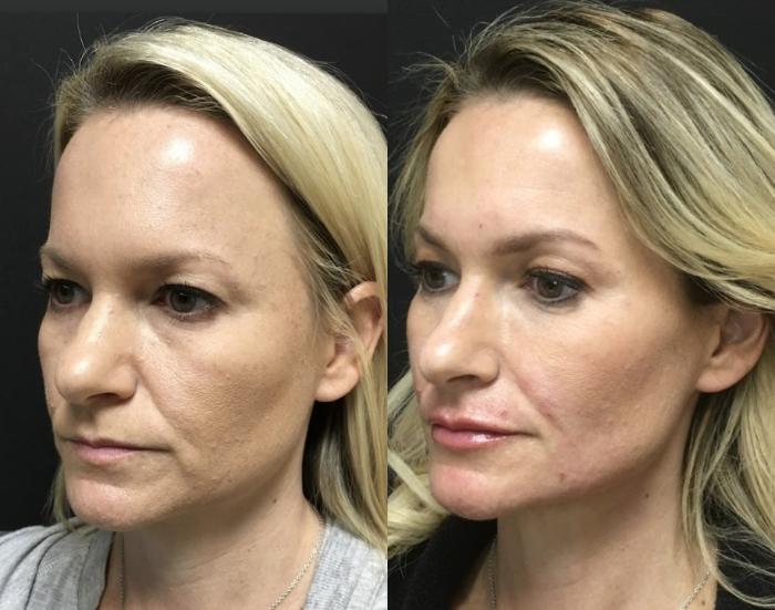 Injectables & Fillers Before & After Case 26636