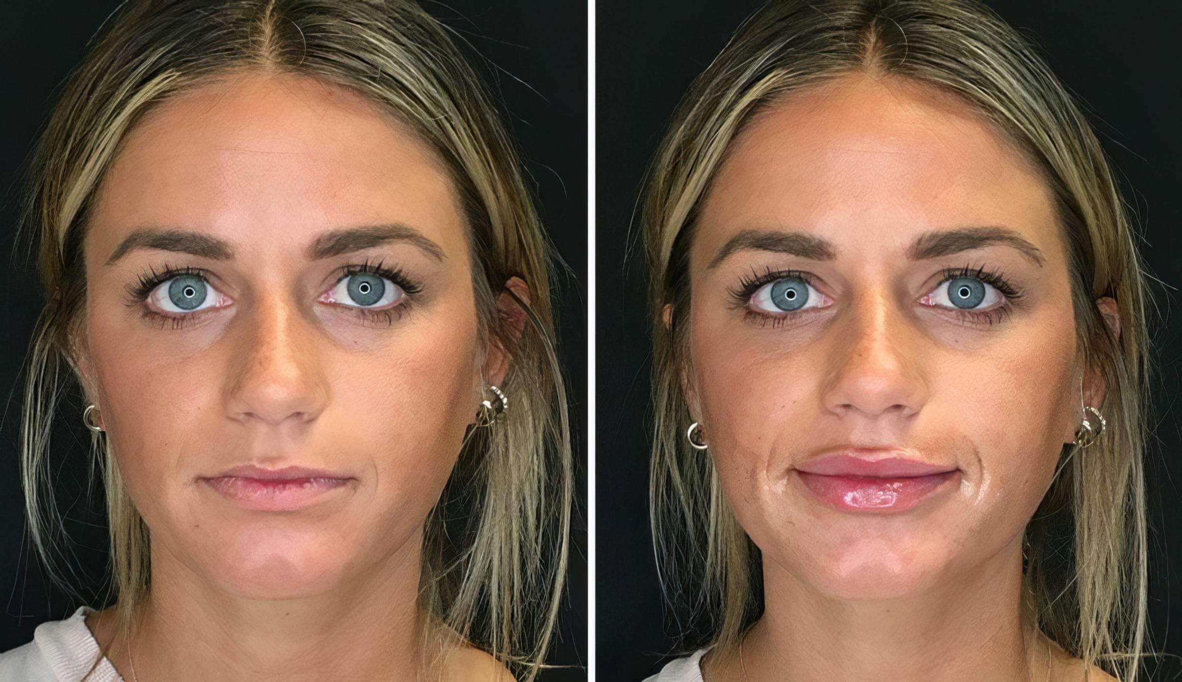 Injectables & Fillers Before & After Case 26639