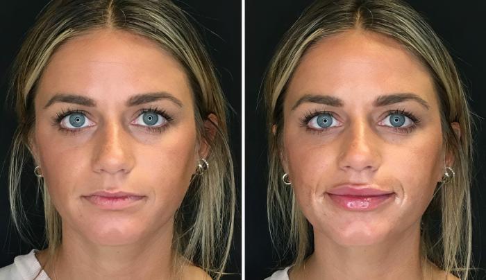 Injectables & Fillers Before & After Case 26639