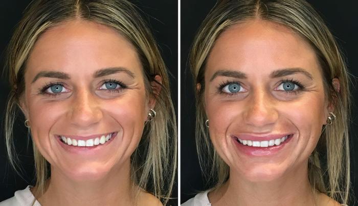 Injectables & Fillers Before & After Case 26639