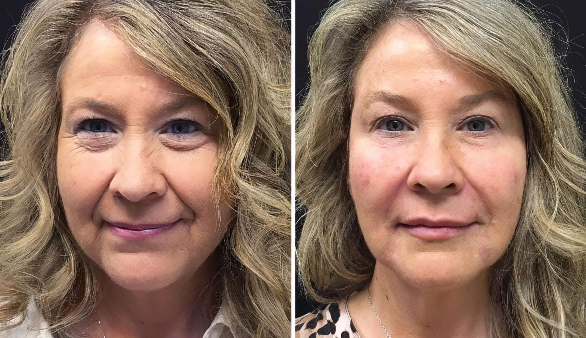 Injectables & Fillers Before & After Case 26642