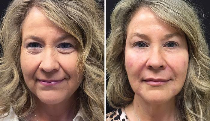 Injectables & Fillers Before & After Case 26642