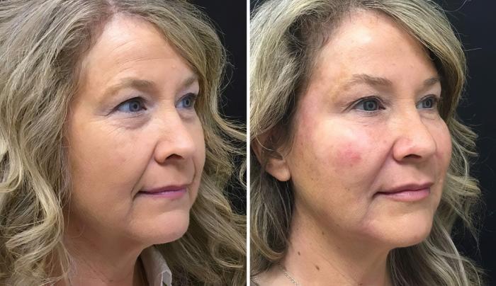 Injectables & Fillers Before & After Case 26642