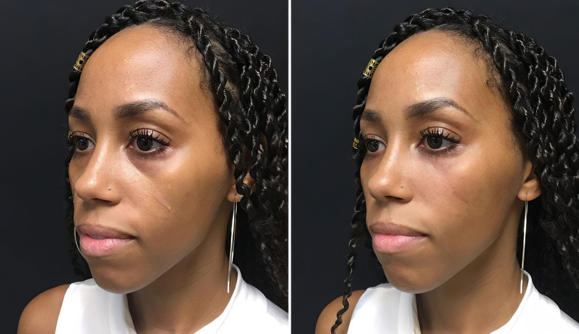 Injectables & Fillers Before & After Case 26645