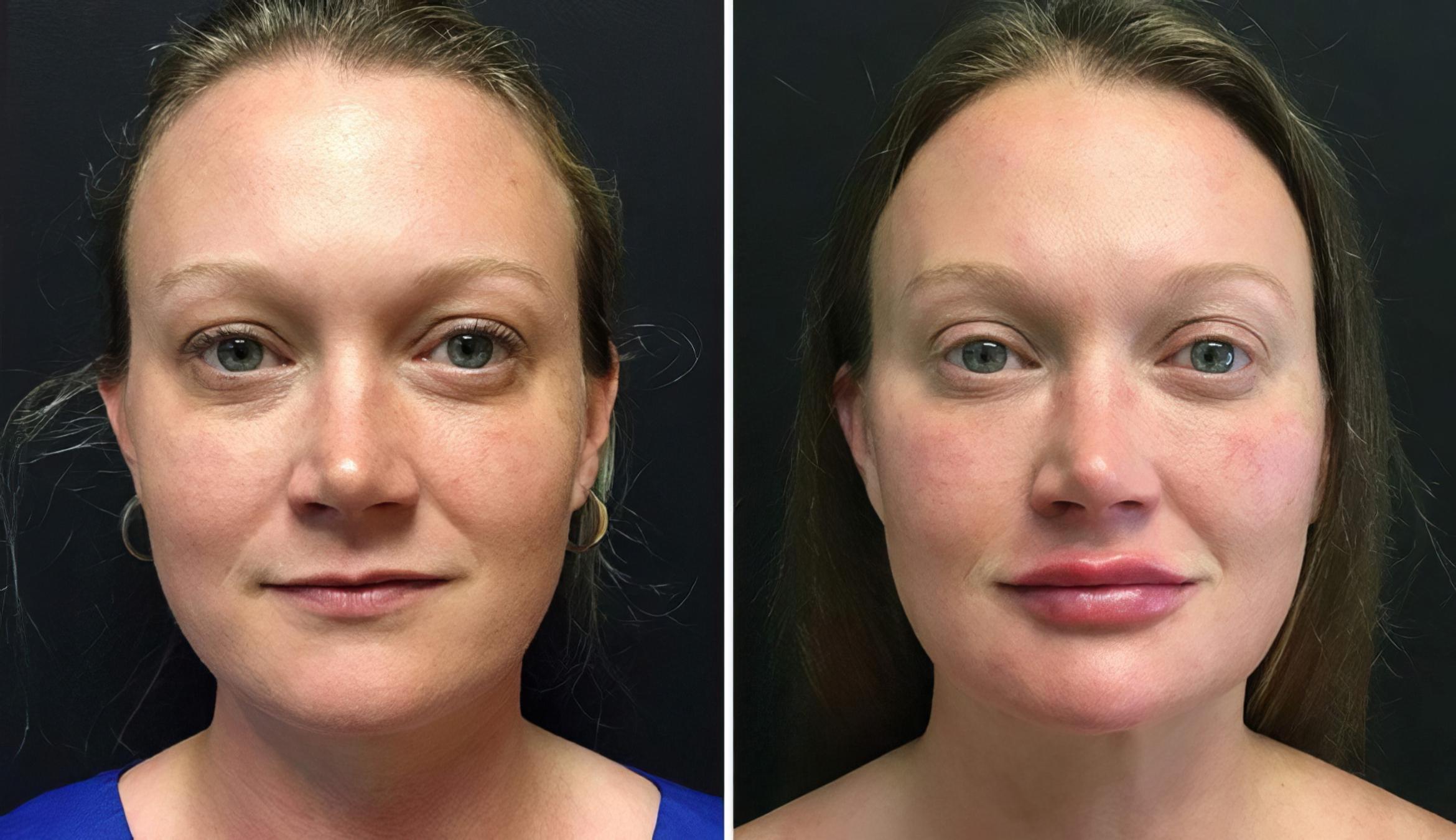 Injectables & Fillers Before & After Case 26647