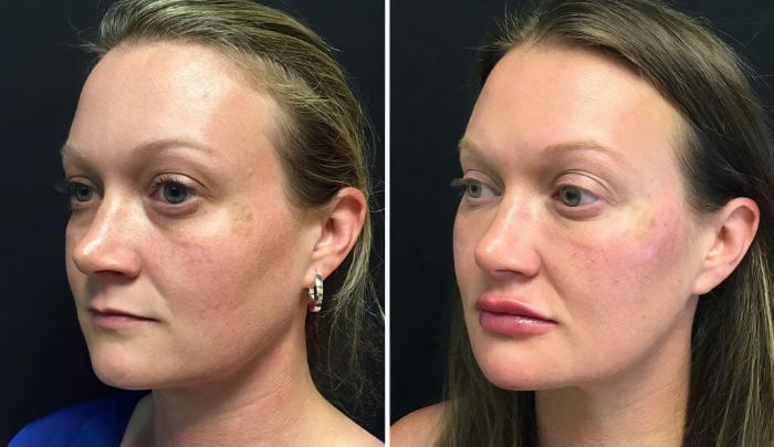 Injectables & Fillers Before & After Case 26647