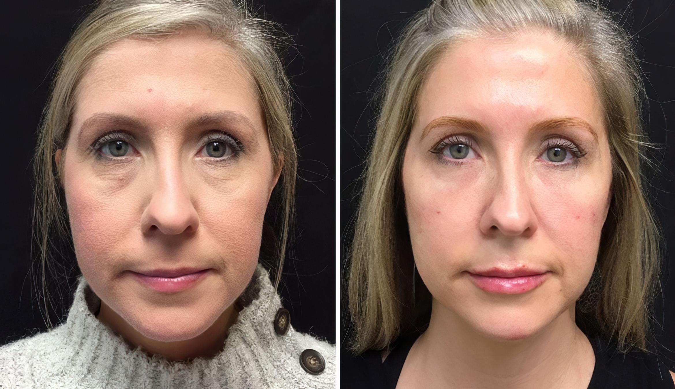 Injectables & Fillers Before & After Case 26650