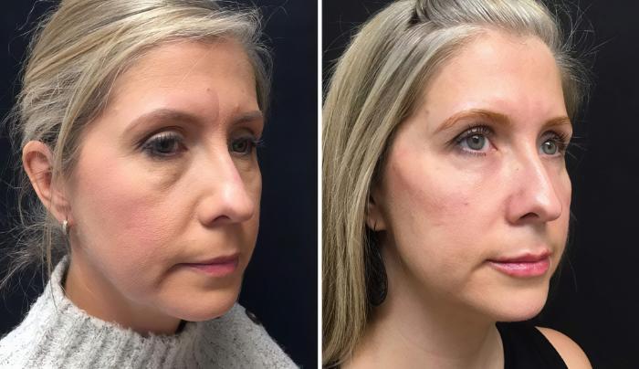Injectables & Fillers Before & After Case 26650