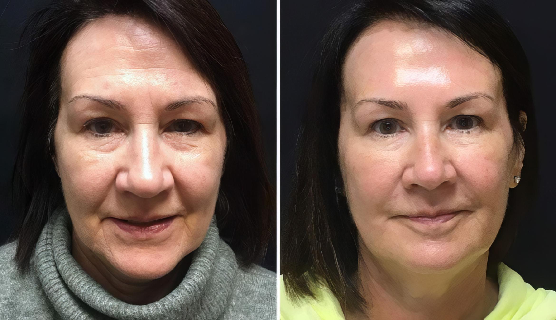Injectables & Fillers Before & After Case 26653