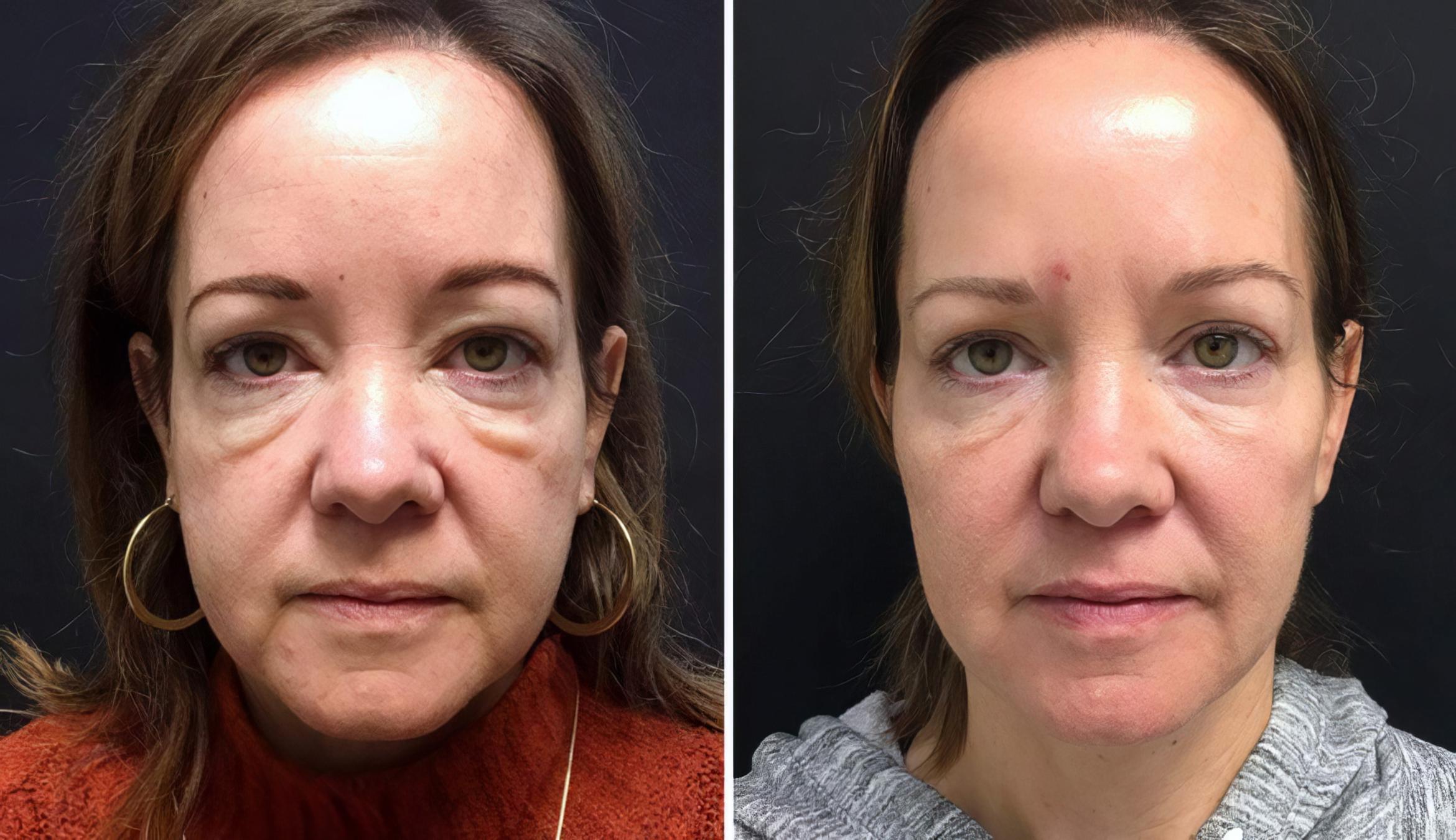 Injectables & Fillers Before & After Case 26656