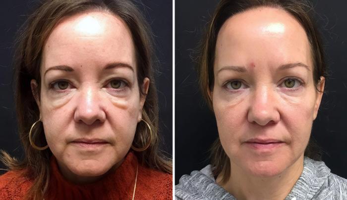 Injectables & Fillers Before & After Case 26656