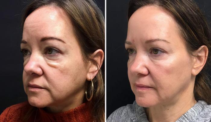 Injectables & Fillers Before & After Case 26656