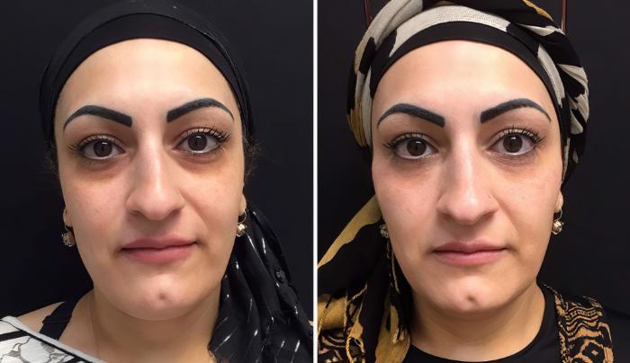 Injectables & Fillers Before & After Case 26659