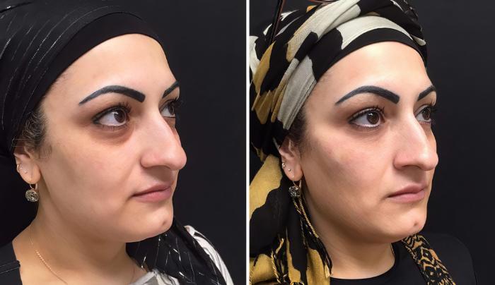 Injectables & Fillers Before & After Case 26659