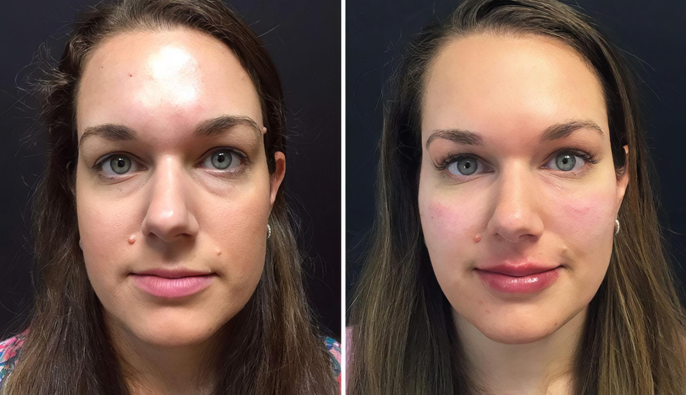 Injectables & Fillers Before & After Case 26662