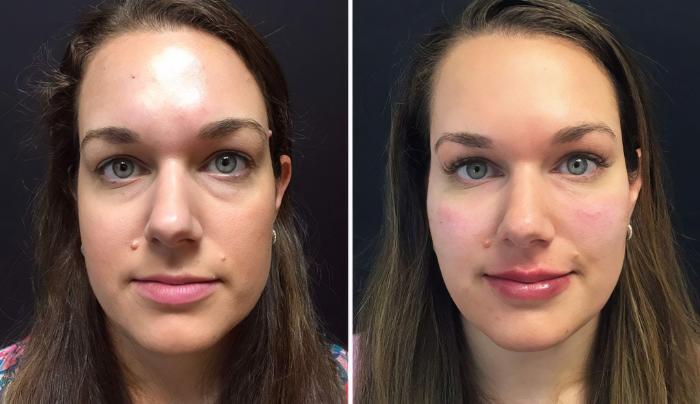 Injectables & Fillers Before & After Case 26662