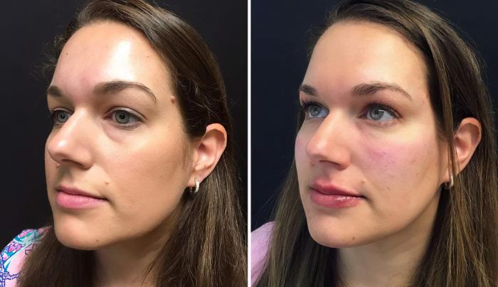 Injectables & Fillers Before & After Case 26662