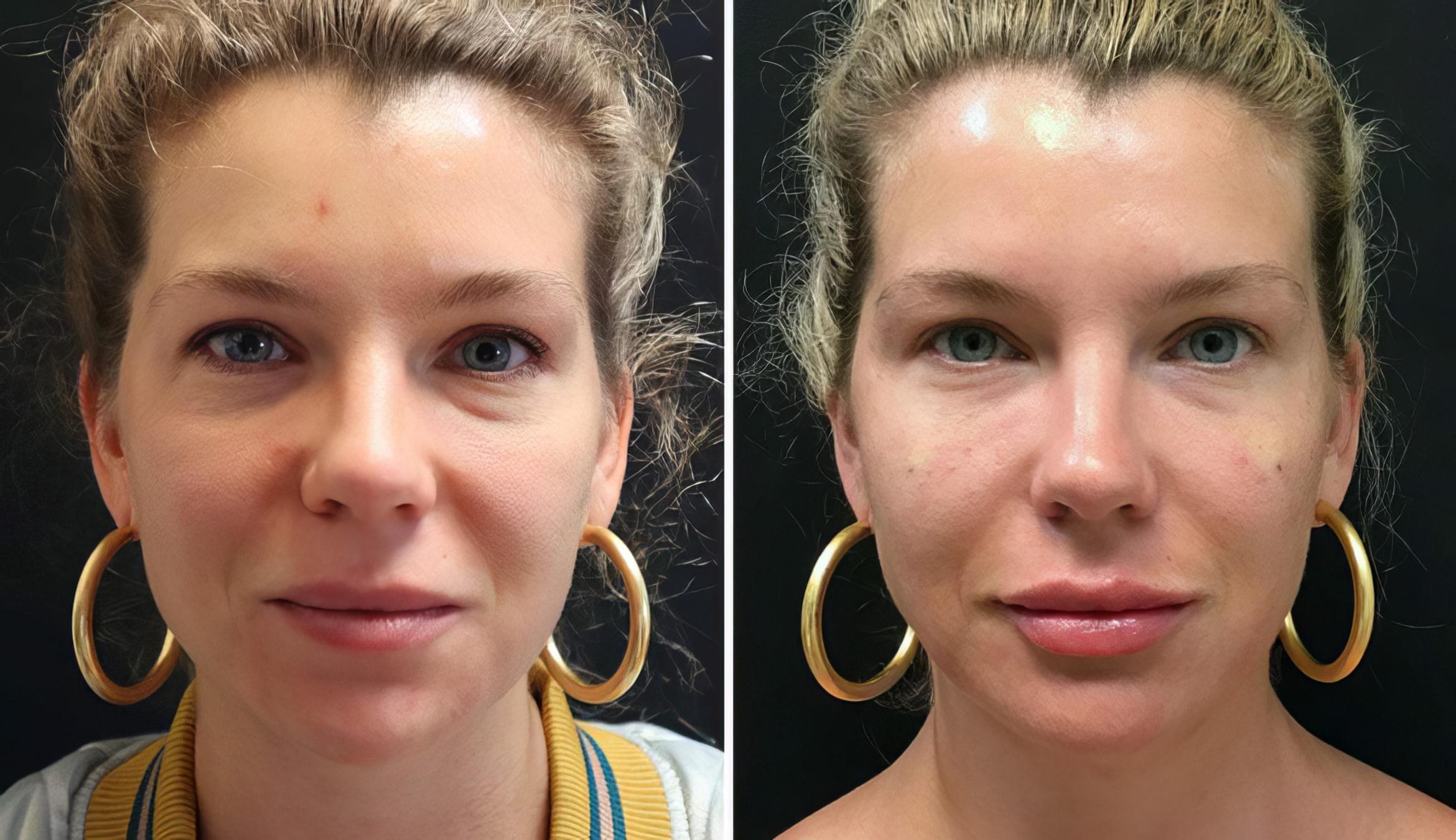 Injectables & Fillers Before & After Case 26665