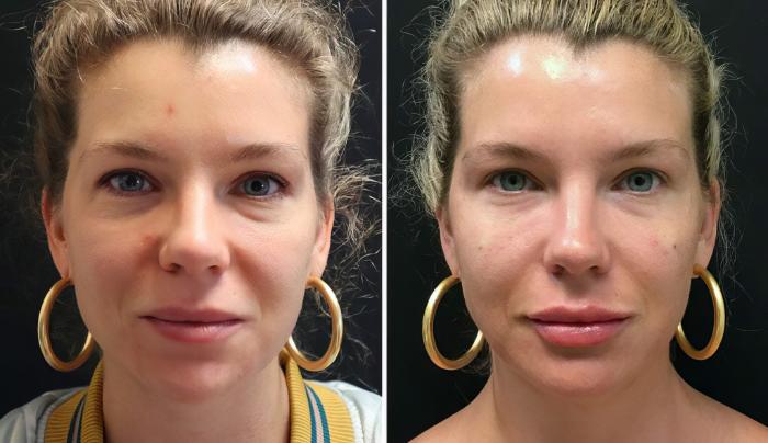 Injectables & Fillers Before & After Case 26665