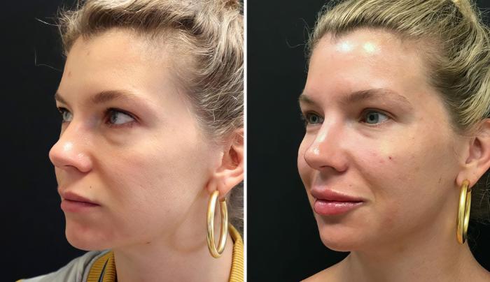 Injectables & Fillers Before & After Case 26665