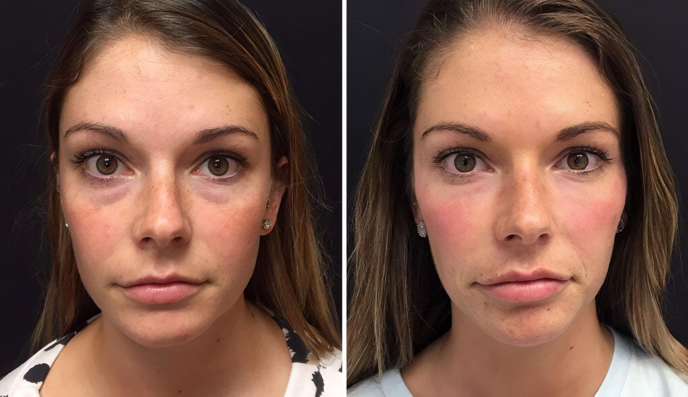 Injectables & Fillers Before & After Case 26668