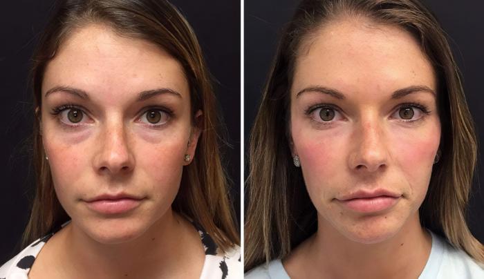 Injectables & Fillers Before & After Case 26668