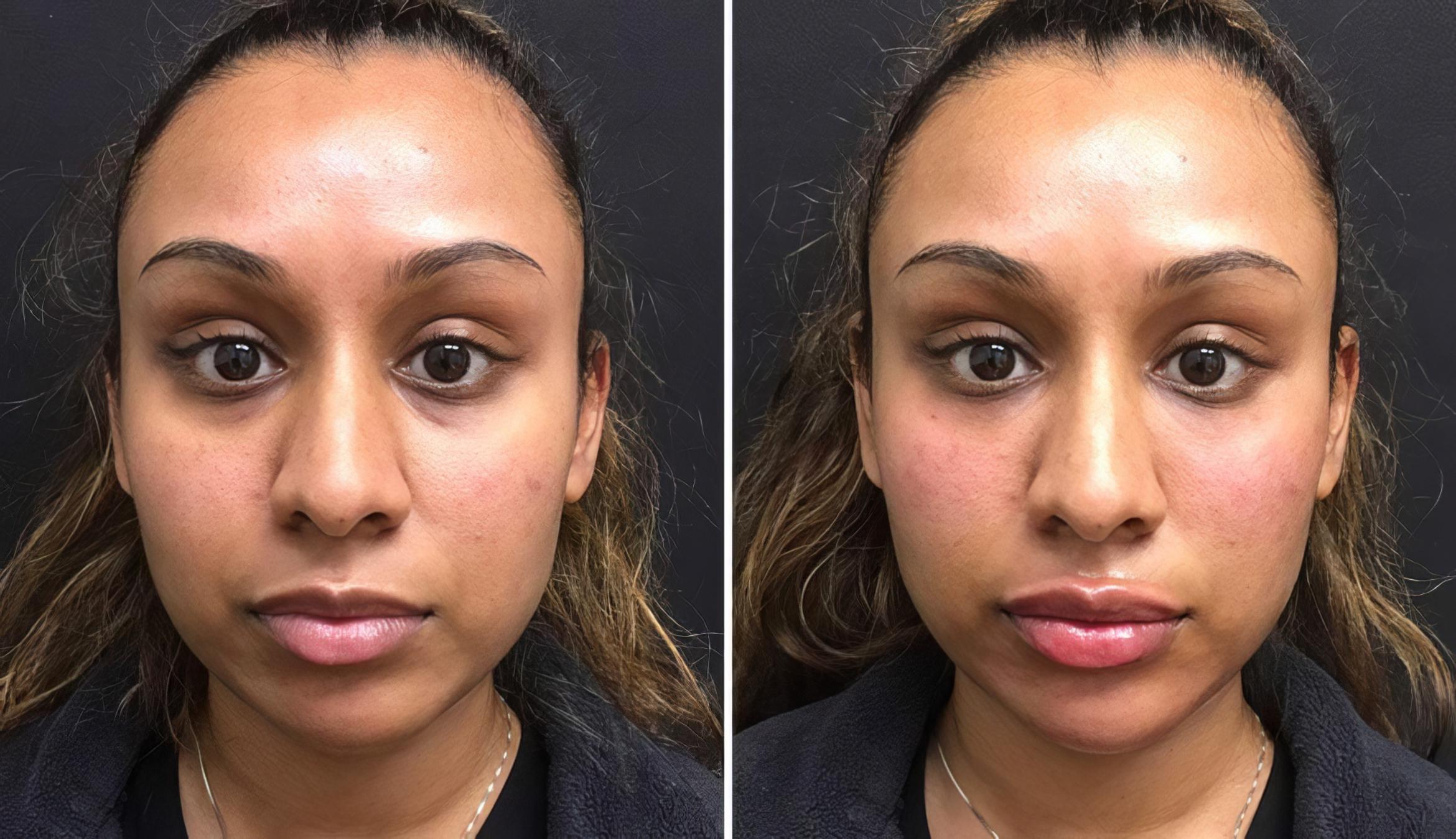 Injectables & Fillers Before & After Case 26670
