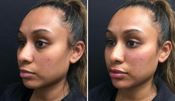 Injectables & Fillers Before & After Case 26670