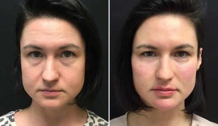 Injectables & Fillers Before & After Case 26673