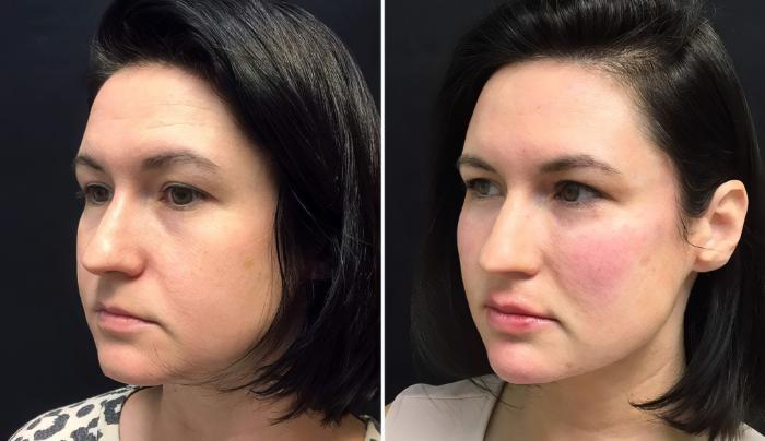 Injectables & Fillers Before & After Case 26673