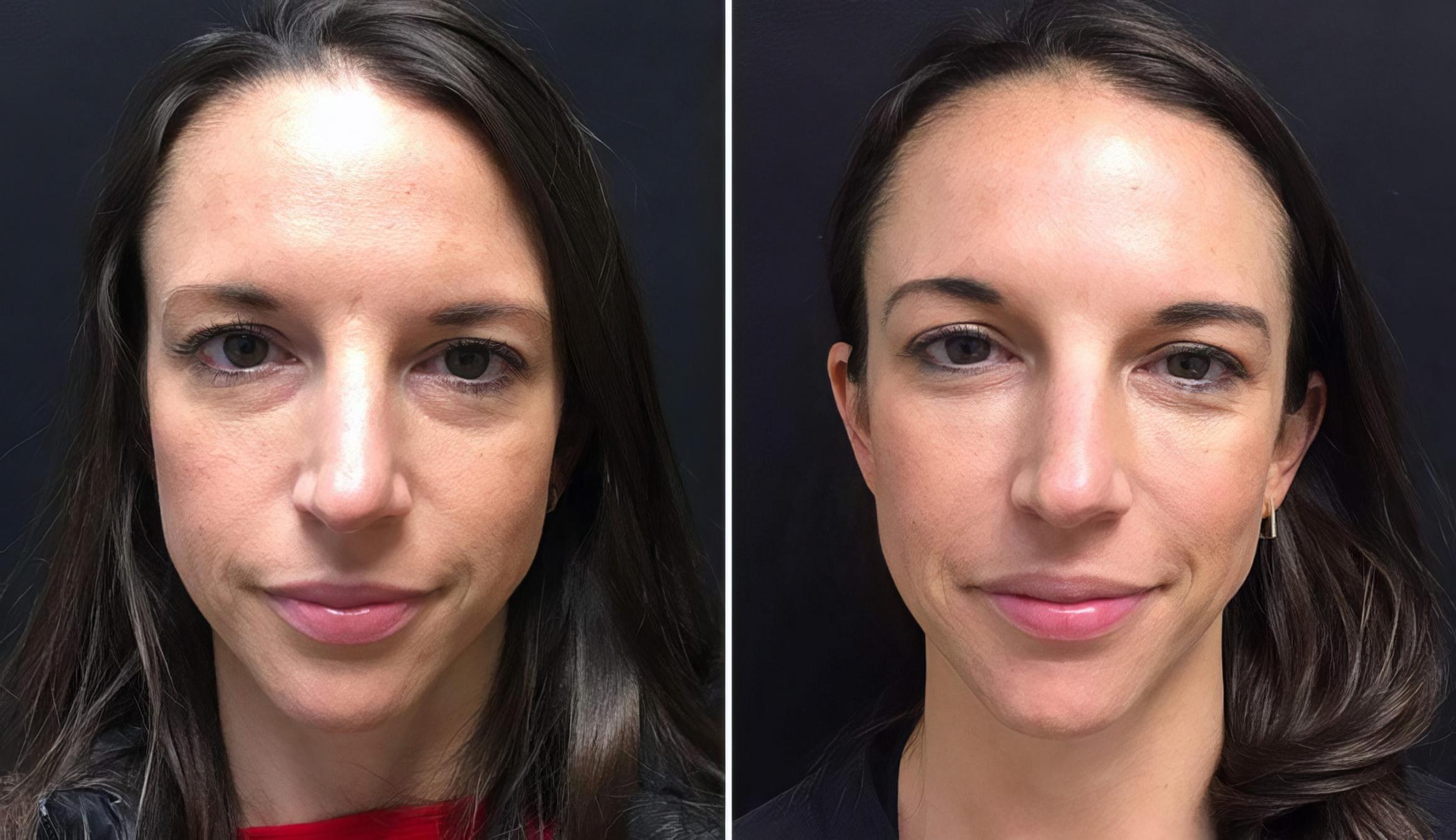 Injectables & Fillers Before & After Case 26676