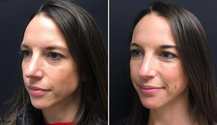 Injectables & Fillers Before & After Case 26676