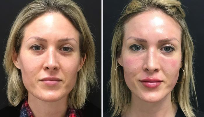 Injectables & Fillers Before & After Case 26679