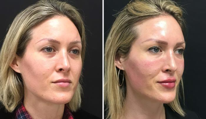Injectables & Fillers Before & After Case 26679
