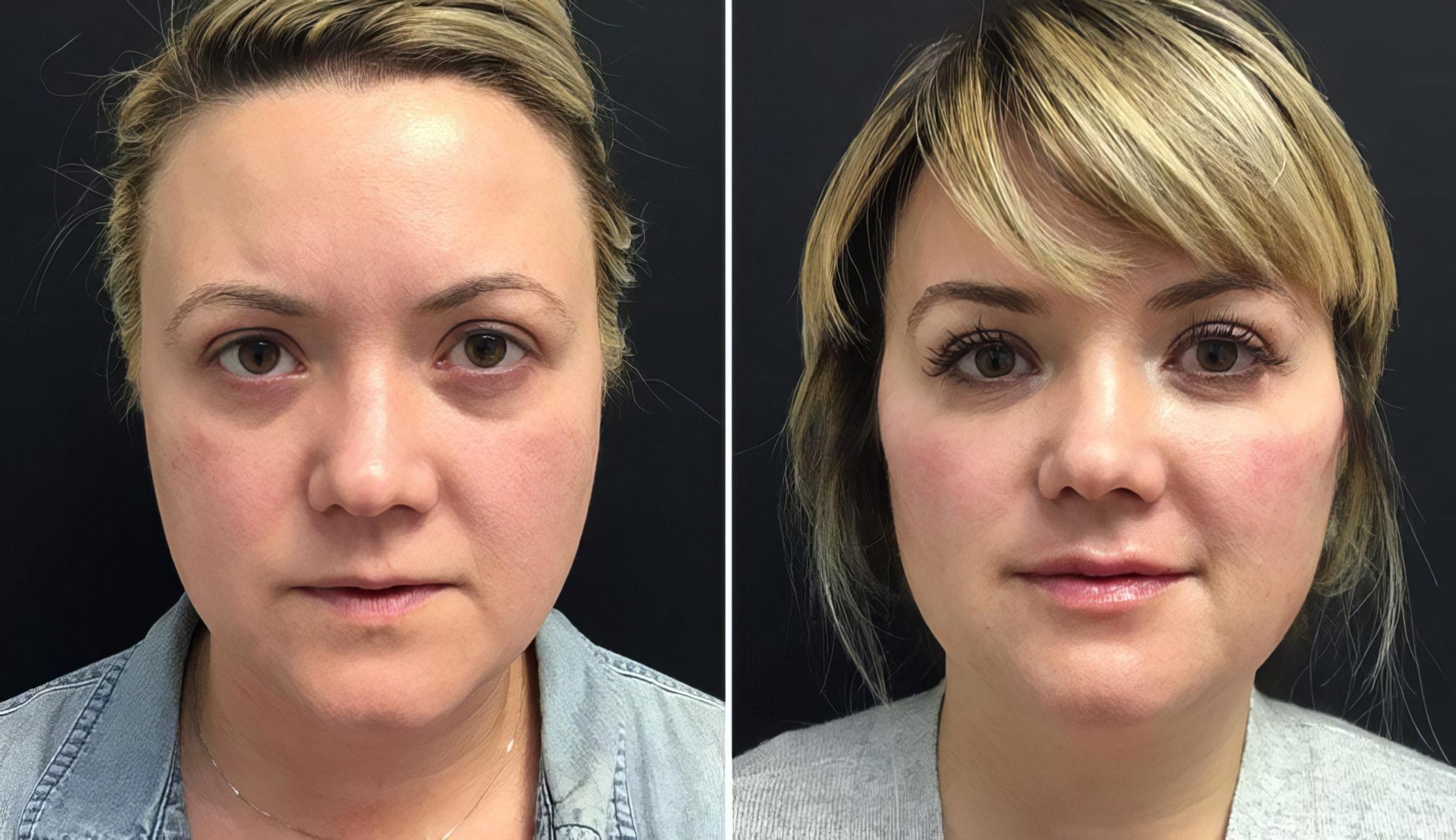 Injectables & Fillers Before & After Case 26682