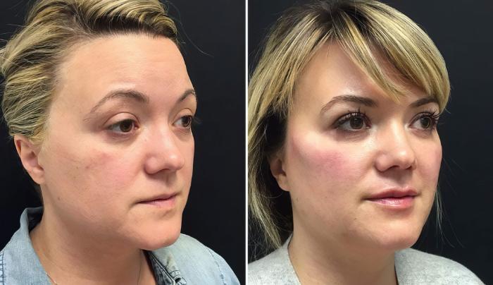 Injectables & Fillers Before & After Case 26682