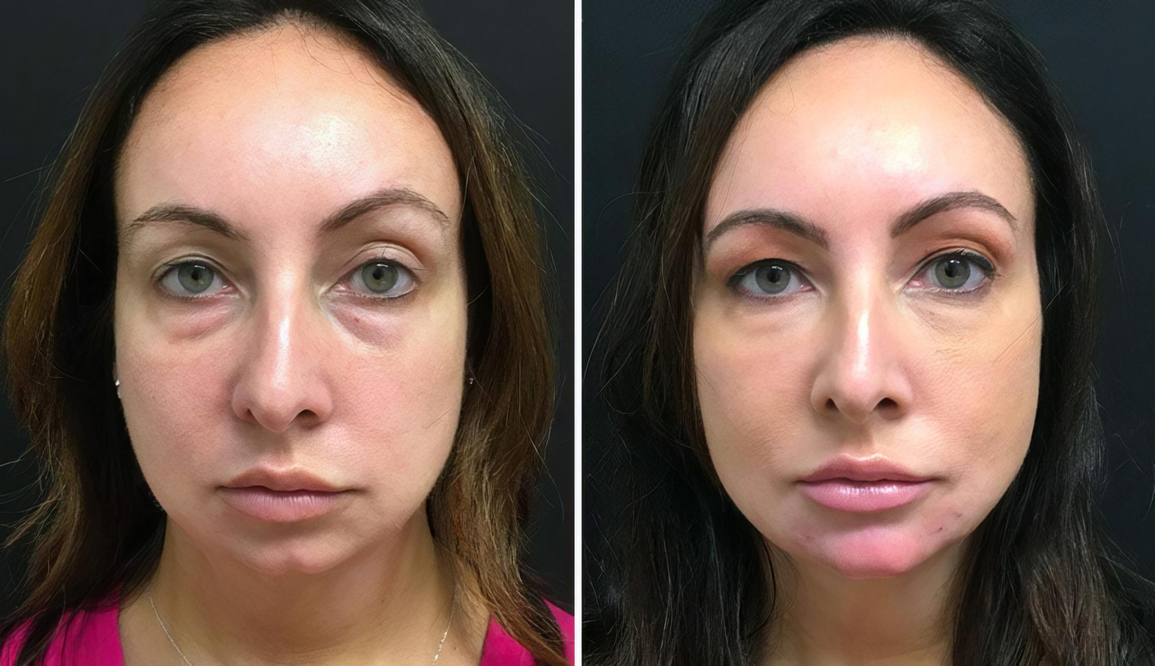 Injectables & Fillers Before & After Case 26685