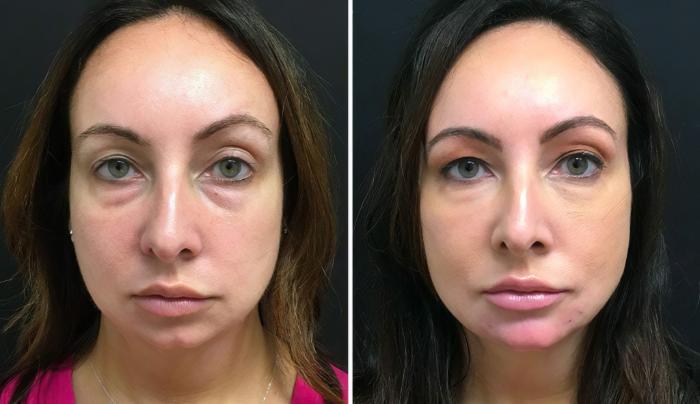 Injectables & Fillers Before & After Case 26685