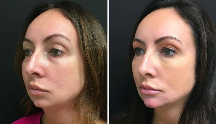 Injectables & Fillers Before & After Case 26685
