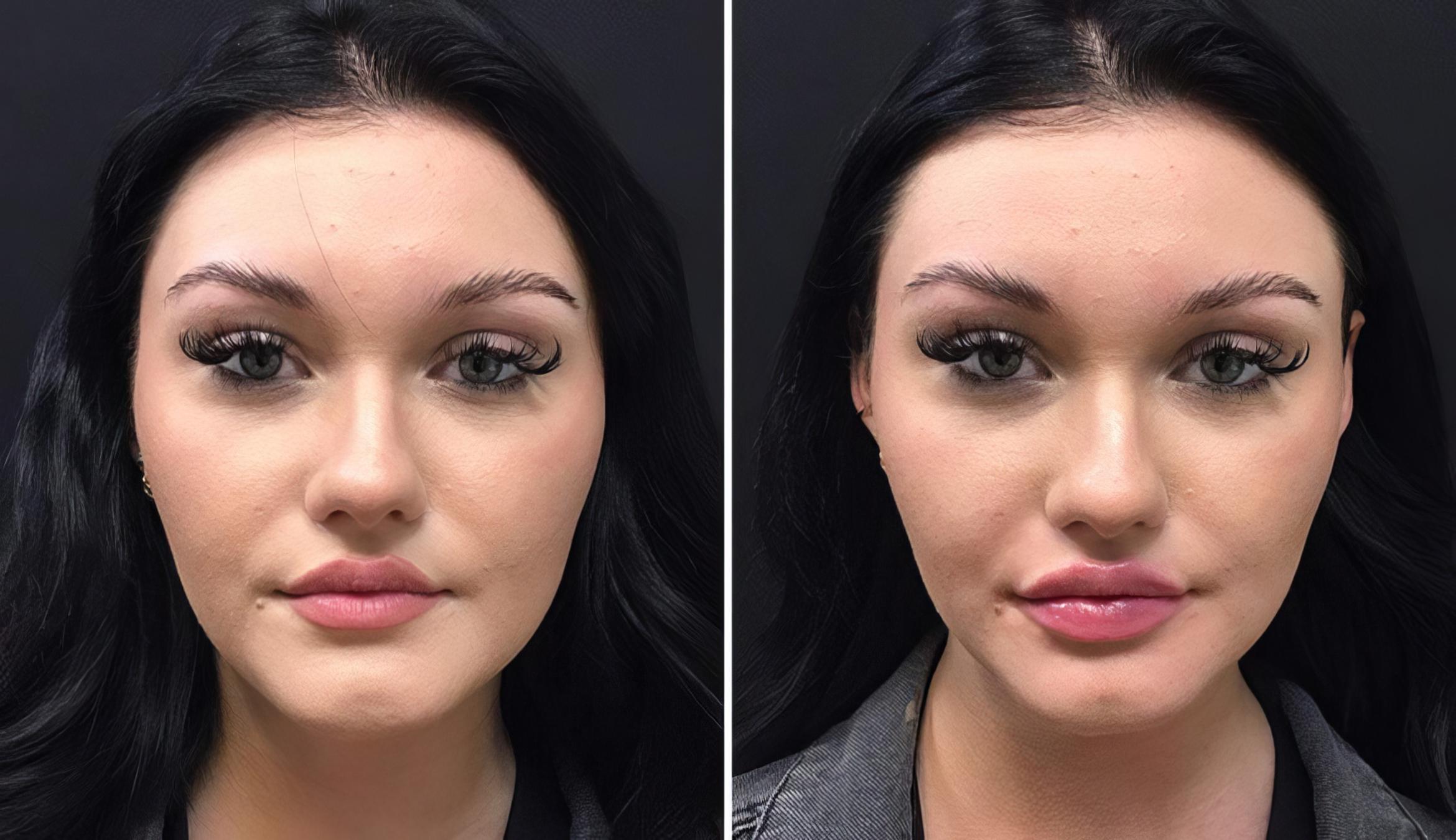 Injectables & Fillers Before & After Case 26689