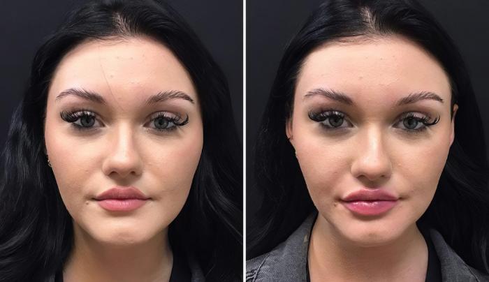Injectables & Fillers Before & After Case 26689