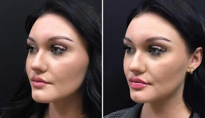 Injectables & Fillers Before & After Case 26689