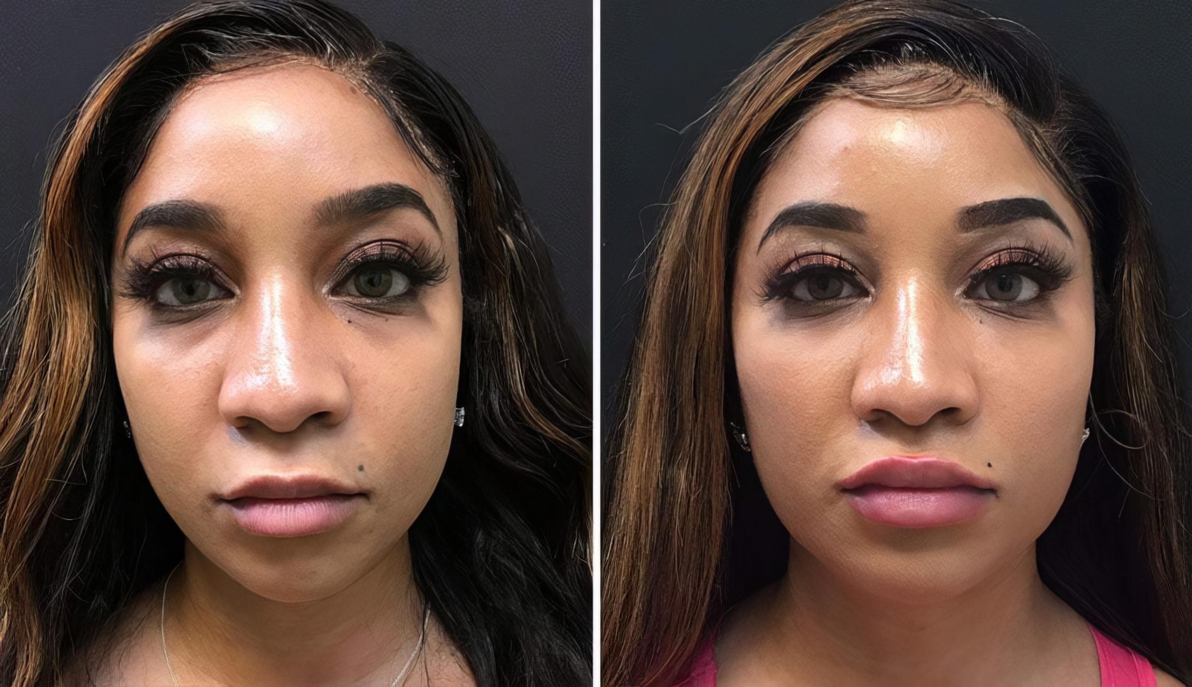 Injectables & Fillers Before & After Case 26784