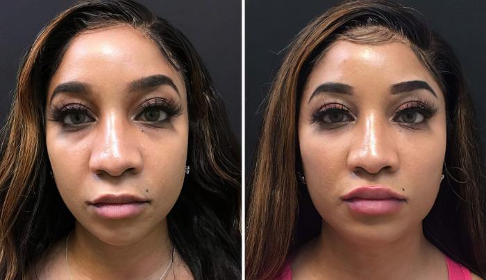 Injectables & Fillers Before & After Case 26784