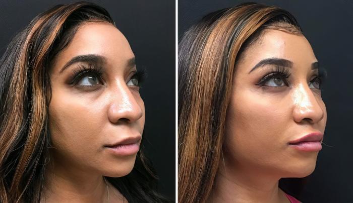 Injectables & Fillers Before & After Case 26784