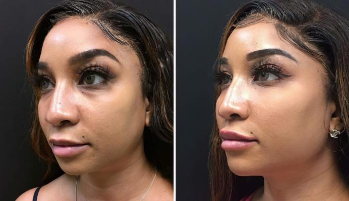 Injectables & Fillers Before & After Case 26784
