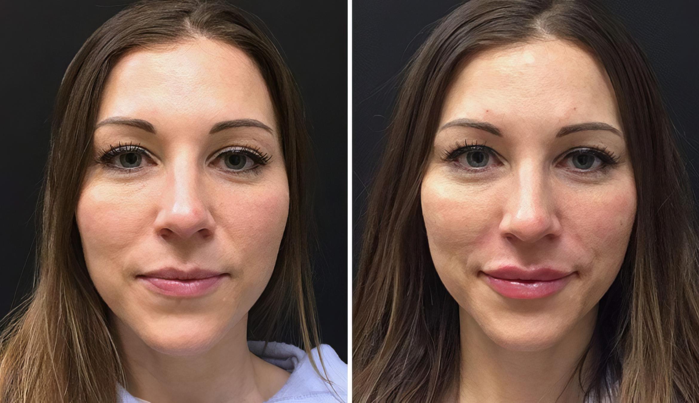 Injectables & Fillers Before & After Case 26788